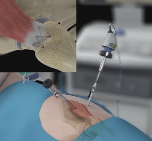 Arthroscopic Gluteus Medius Tendon Repair pic