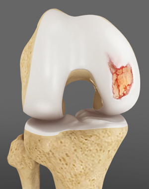 Articular Cartilage Injury (Knee) pic