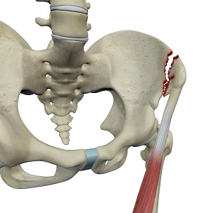 Avulsion Fractures of the Pelvis pic