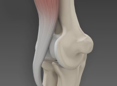 Biceps Tendon Repair