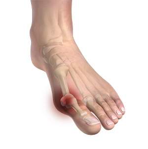 Bunion pic