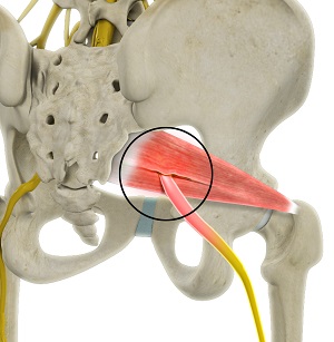 Deep Gluteal Pain Syndrome pic