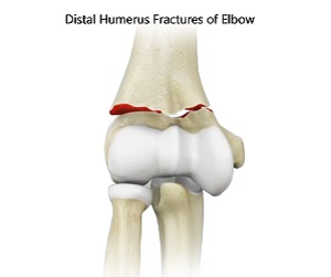Distal Humerus Fractures of the Elbow pic