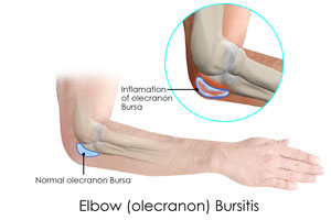 Elbow (Olecranon) Bursitis pic