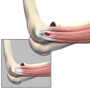 Epicondylitis pic