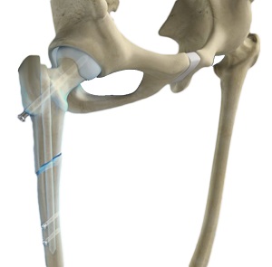 Femoral Nails pic
