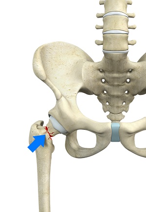 Femoral Neck Fracture pic