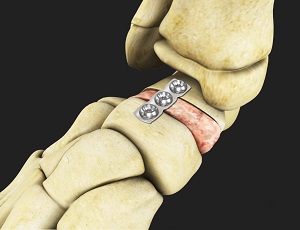 Flatfoot Reconstruction 