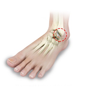 Foot and Ankle Arthritis pic