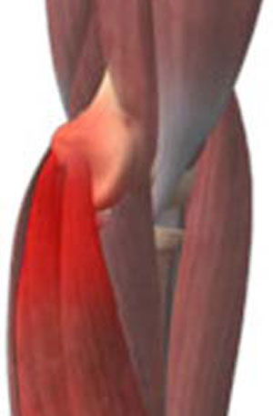 Golfer's Elbow pic