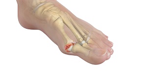 Hallux Rigiditis