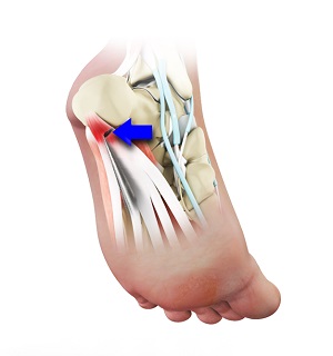 Heel Surgery