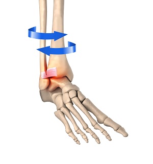 High Ankle Sprain pic