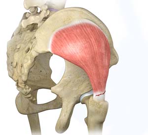 Hip Abductor Tears pic
