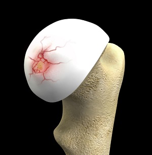 Hip Cartilage Repair pic