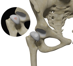 Hip Cartilage Restoration pic