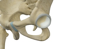 Hip Labral Augmentation pic