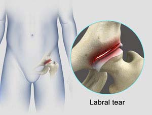 Hip Labral Tear pic