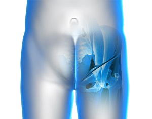 Iliopsoas Tendonitis pic