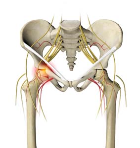 Irritable Hip pic