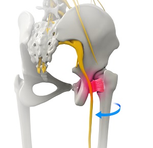 Ischiofemoral Impingement pic