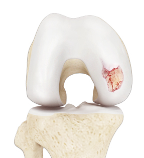 Knee Arthritis pic