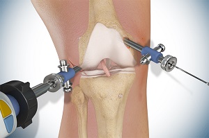 Knee Surgery
