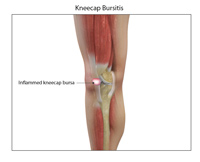 Kneecap Bursitis pic