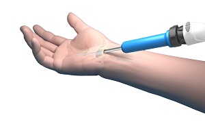 Minimally Invasive Hand and Wrist Surgery pic