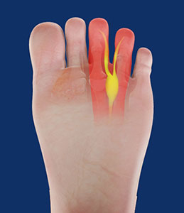 Morton's Neuroma pic