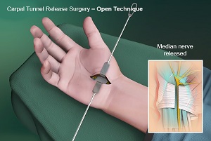 Open Carpal Tunnel Release Surgery pic