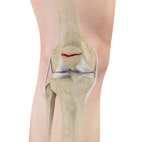 Patella Fracture pic