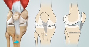 Patella Stabilization