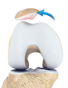 Patellar Instability pic