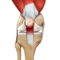 Patellar Tendonitis pic