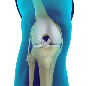 Primary ACL Repair