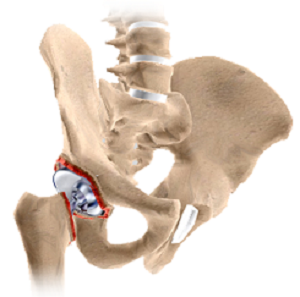 Revision Hip Replacement pic