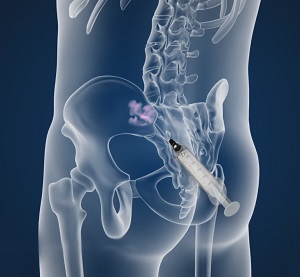 Sacroiliac Joint Injections pic