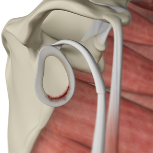 Shoulder Labral Tear pic