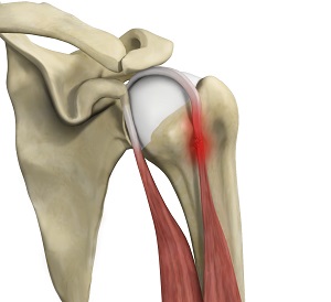 Tendinitis