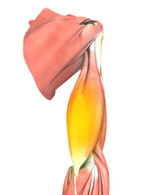 Triceps Tendonitis pic