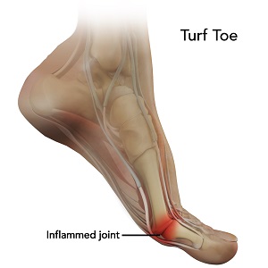 Turf Toe pic