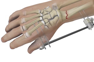 Wrist Fracture Fixation pic
