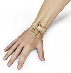 Wrist Injuries and Conditions