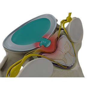 Cervical Disc Herniation pic