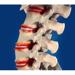 Degenerative spine surgery pic