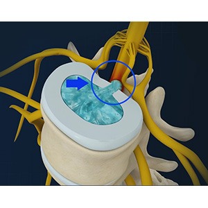 Disc Herniation pic