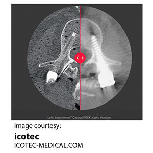 icotec® Carbon/PEEK Spinal Implant Surgery pic