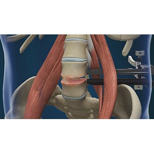 Lumbar Discectomy pic