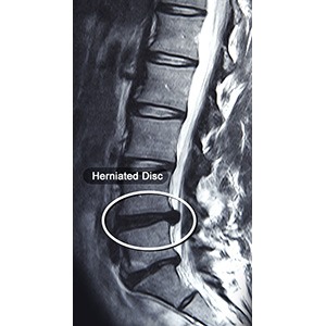 Lumbar Herniated Disc pic